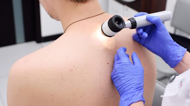 Hautkrebs-Screening