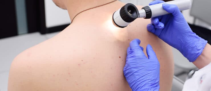 Hautkrebs-Screening